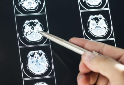 Traumatic Brain Injury Case