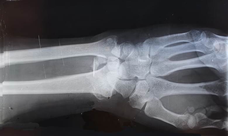 Personal Injury